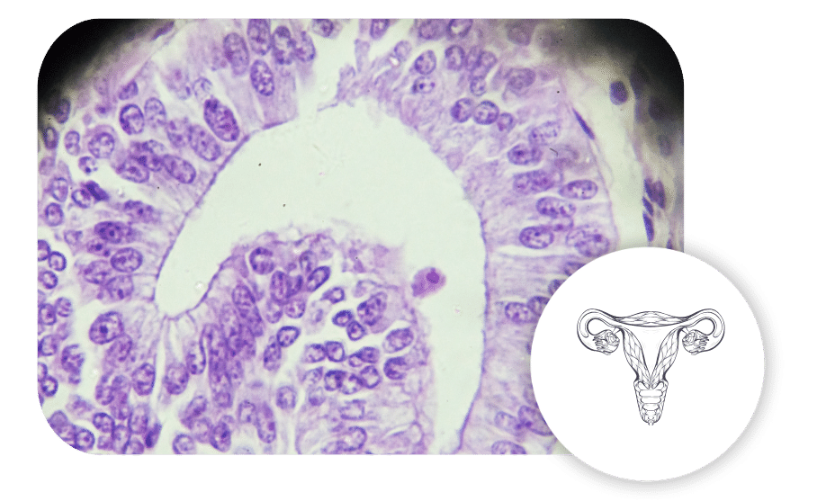 Adenomyosis treatment