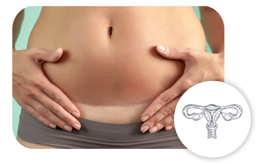 uterus removal surgery