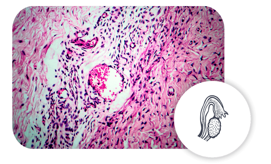 ovary cysts